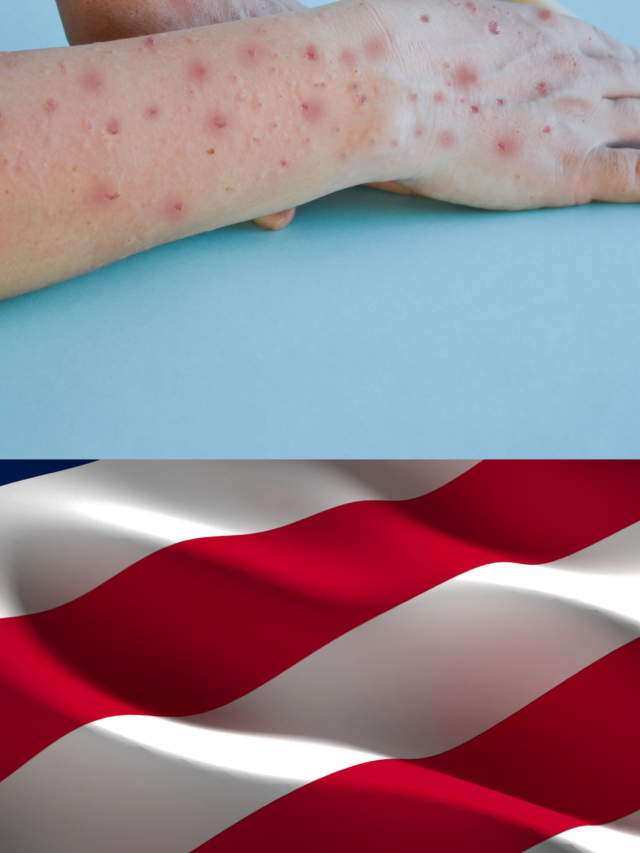 Monkey Pox Virus Now In US? WHO Alerts The Nation